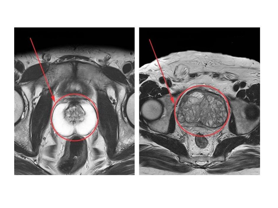 MRI görüntülerinde sağlıklı (sol) ve iltihaplı (sağ) prostatın karşılaştırılması